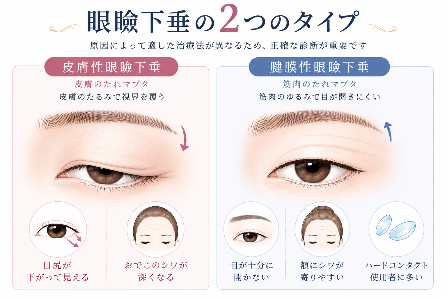 眼瞼下垂の2つの原因