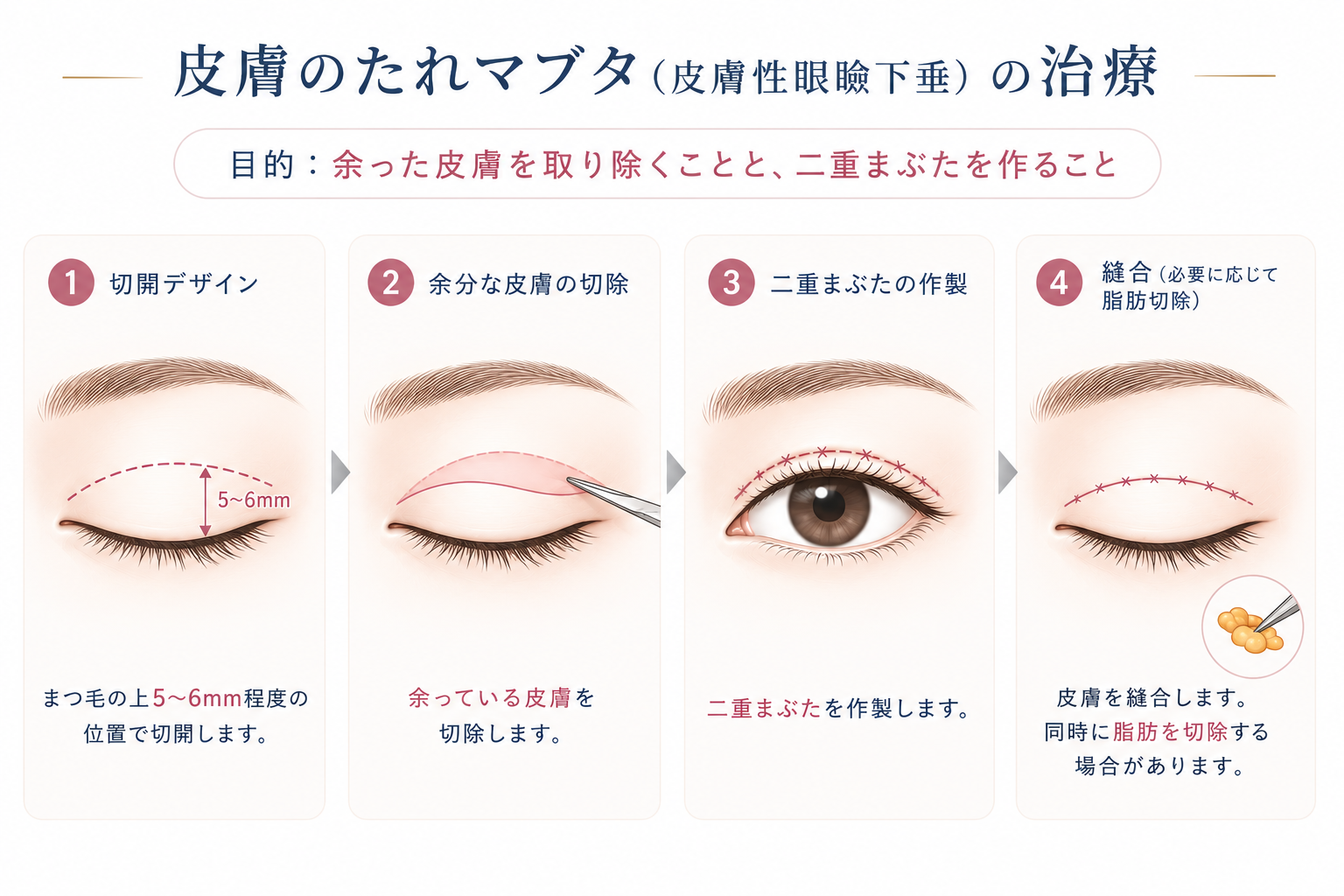 皮膚のたれマブタへの手術

